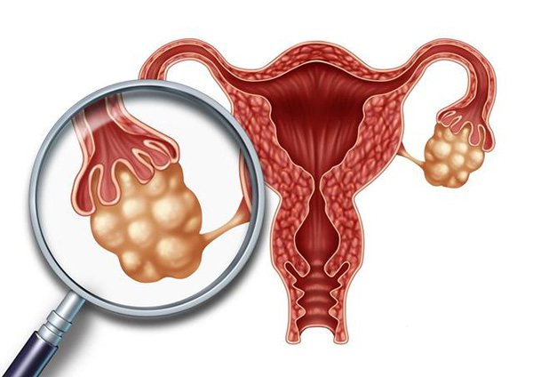 多囊卵巢综合征能怀孕吗