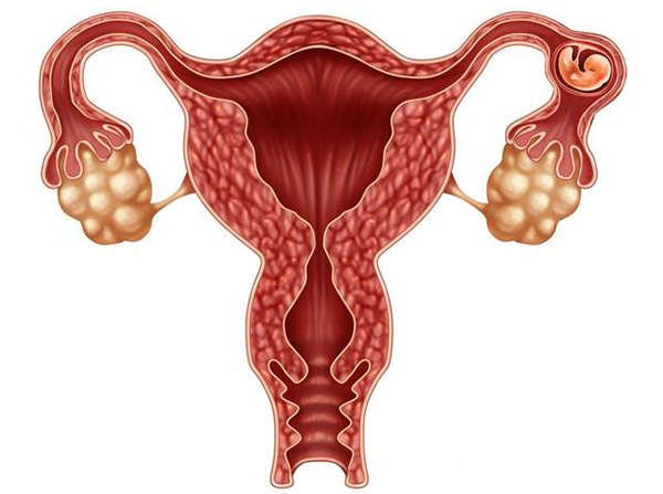 卵巢囊肿能自己消失吗
