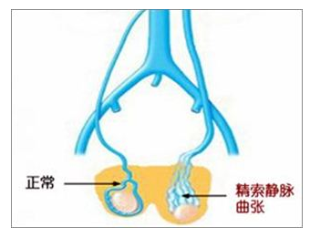 精索静脉曲张需要手术吗