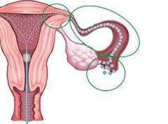 西安治疗女性不孕 输卵管通水非万能