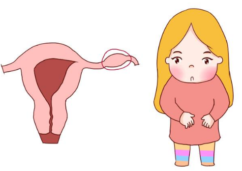 女性宫外孕是什么