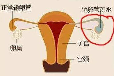 输卵管积水对妊娠到底有多大的影响