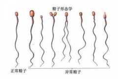 西安男性不育 导致男性精液少的原因有哪些