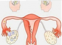 多囊卵巢综合症如何成功怀孕？