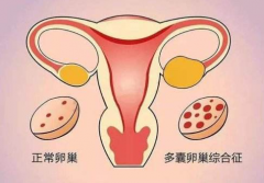 为什么多囊患者的雄激素会出现异常